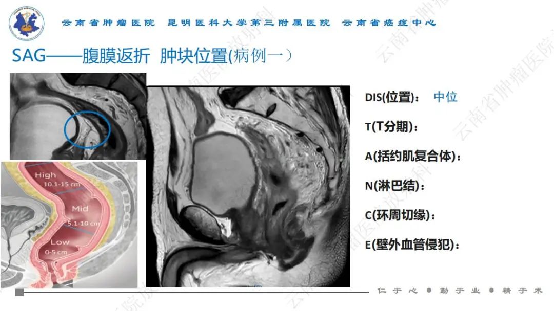 影像PPT - 【PPT】直肠癌磁共振解读-9