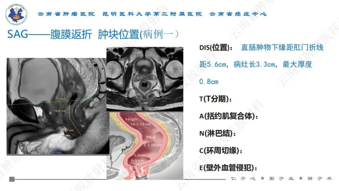 影像PPT - 【PPT】直肠癌磁共振解读-10