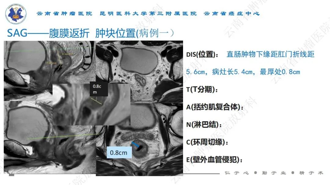 影像PPT - 【PPT】直肠癌磁共振解读-11