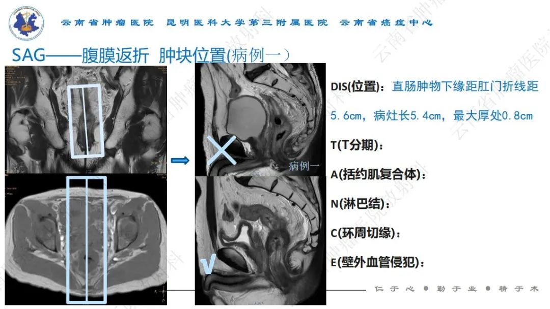 影像PPT - 【PPT】直肠癌磁共振解读-12