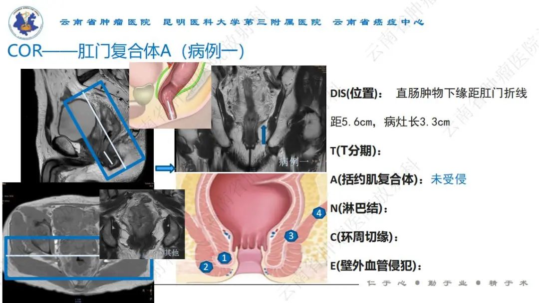 影像PPT - 【PPT】直肠癌磁共振解读-13