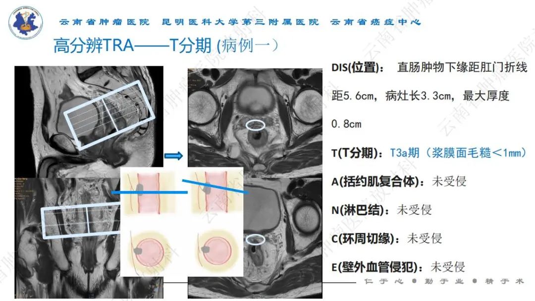影像PPT - 【PPT】直肠癌磁共振解读-14