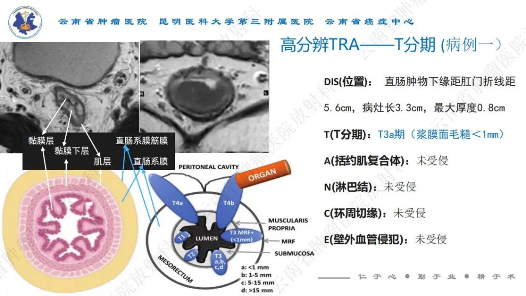 影像PPT - 【PPT】直肠癌磁共振解读-15