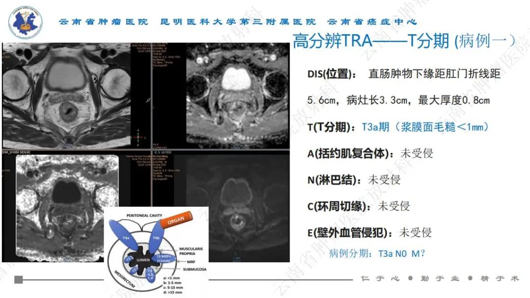 影像PPT - 【PPT】直肠癌磁共振解读-16
