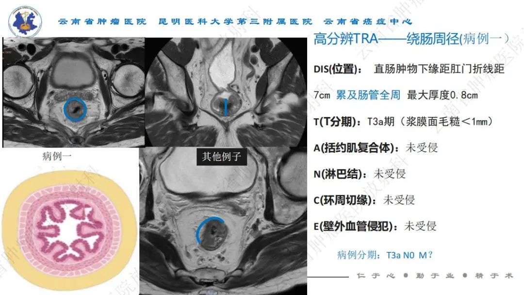 影像PPT - 【PPT】直肠癌磁共振解读-18