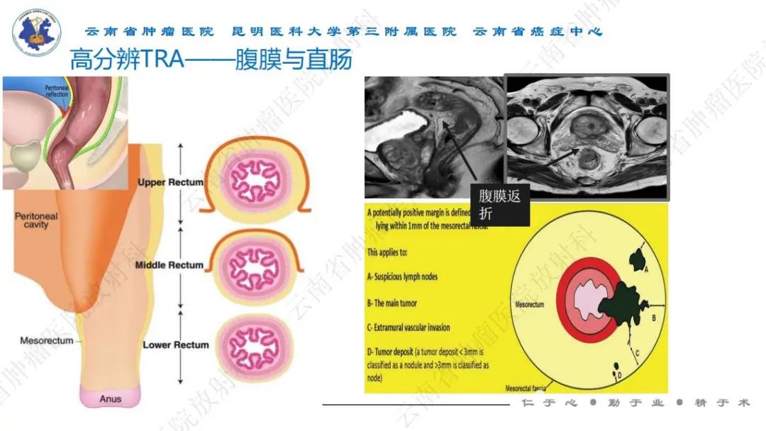 影像PPT - 【PPT】直肠癌磁共振解读-19