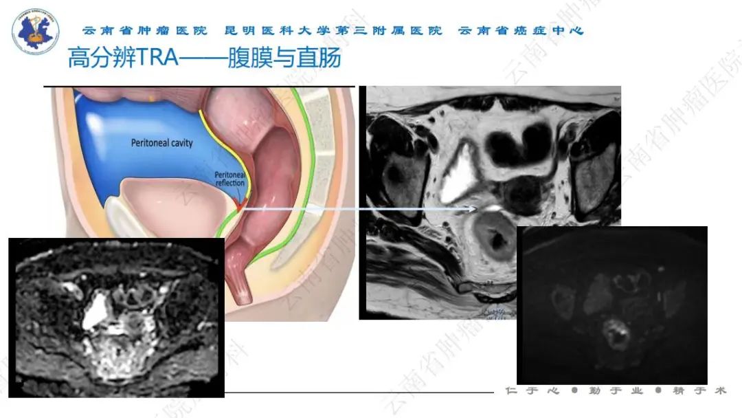 影像PPT - 【PPT】直肠癌磁共振解读-20