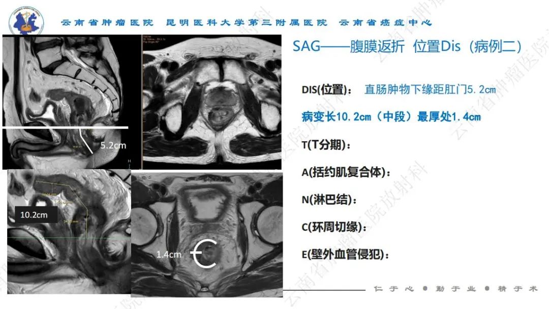 影像PPT - 【PPT】直肠癌磁共振解读-22