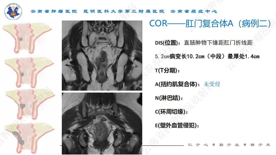 影像PPT - 【PPT】直肠癌磁共振解读-23