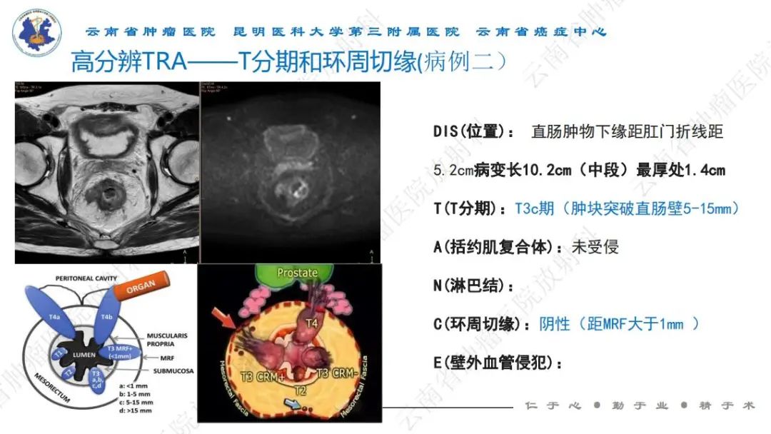 影像PPT - 【PPT】直肠癌磁共振解读-24