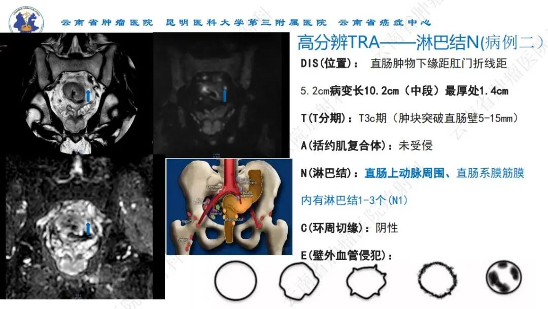 影像PPT - 【PPT】直肠癌磁共振解读-25