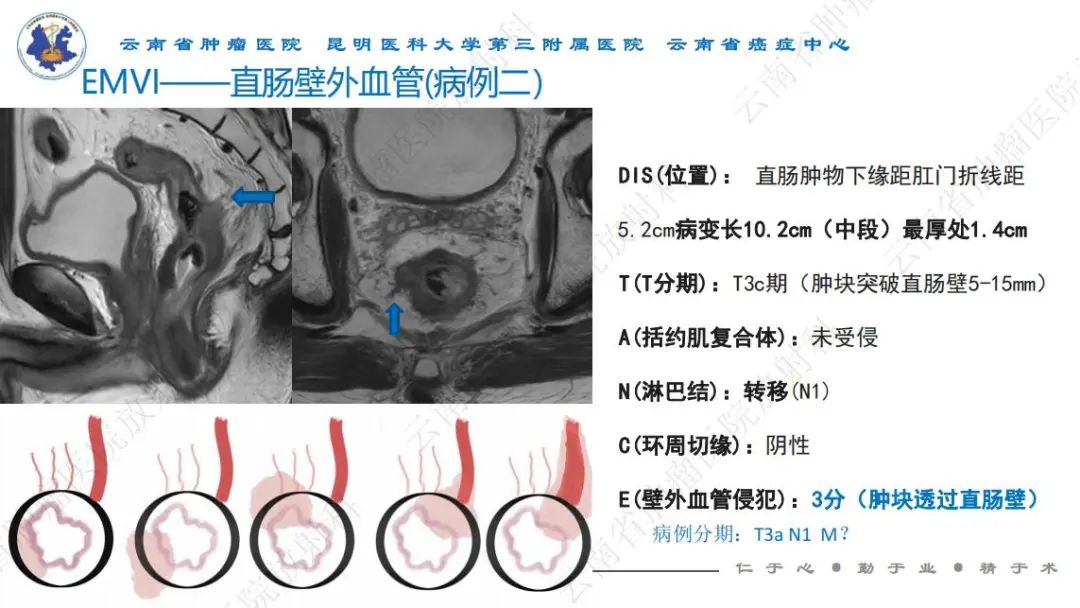影像PPT - 【PPT】直肠癌磁共振解读-26