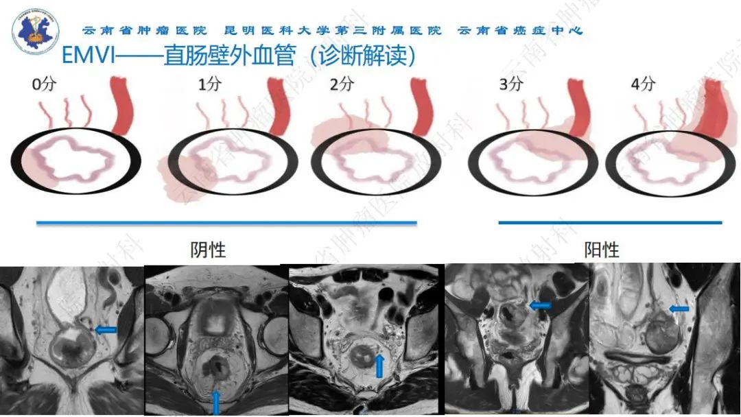 影像PPT - 【PPT】直肠癌磁共振解读-27