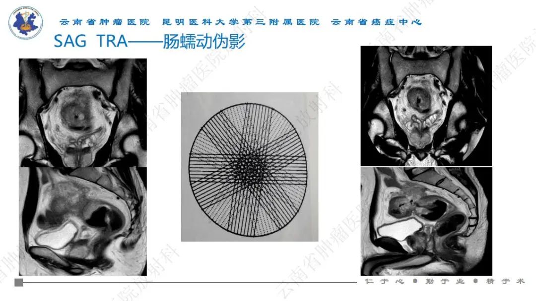 影像PPT - 【PPT】直肠癌磁共振解读-31