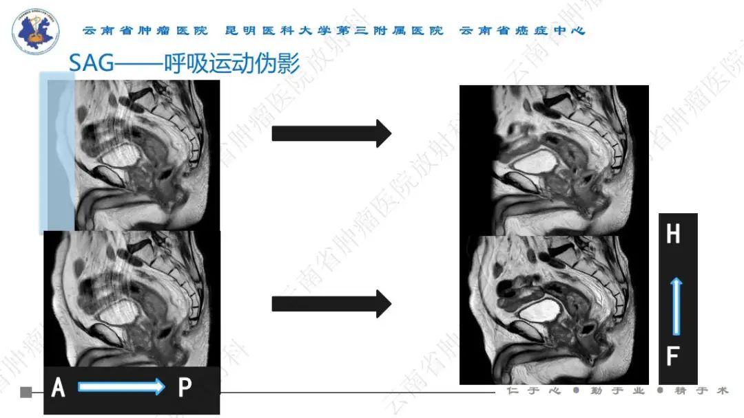 影像PPT - 【PPT】直肠癌磁共振解读-32