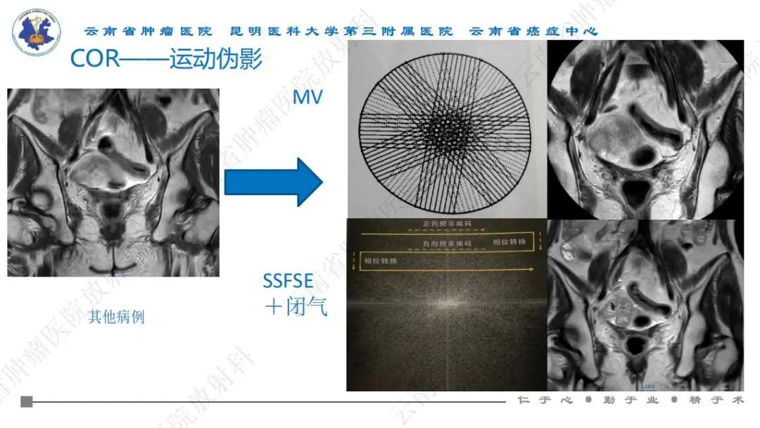 影像PPT - 【PPT】直肠癌磁共振解读-33
