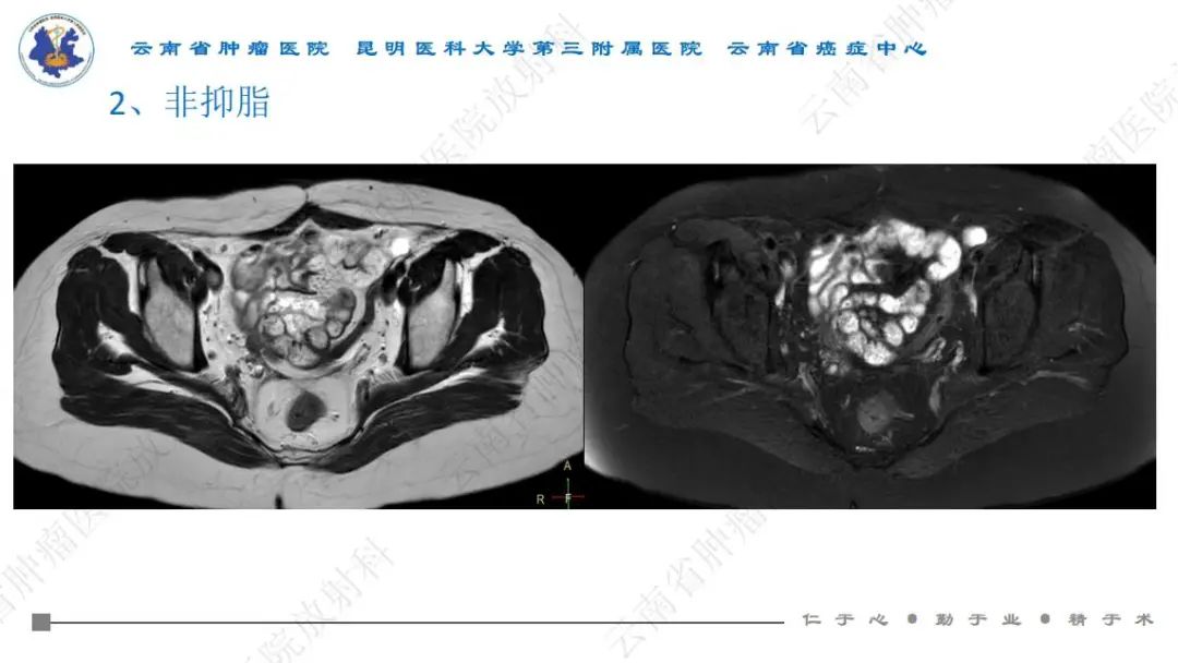 影像PPT - 【PPT】直肠癌磁共振解读-34