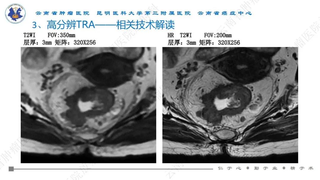 影像PPT - 【PPT】直肠癌磁共振解读-37