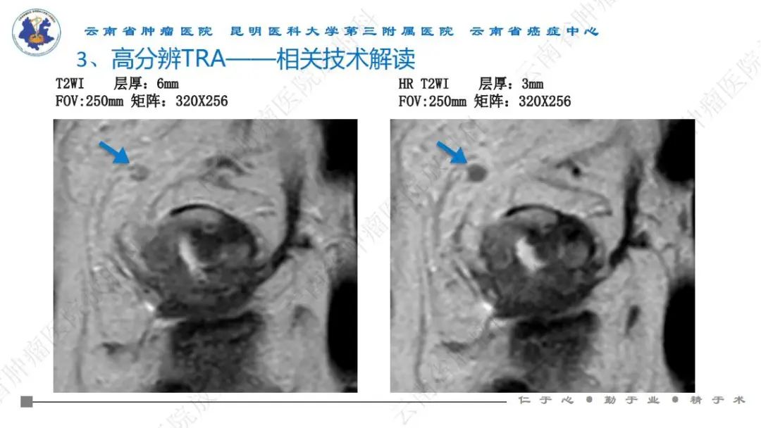 影像PPT - 【PPT】直肠癌磁共振解读-38