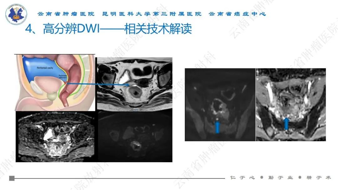 影像PPT - 【PPT】直肠癌磁共振解读-43