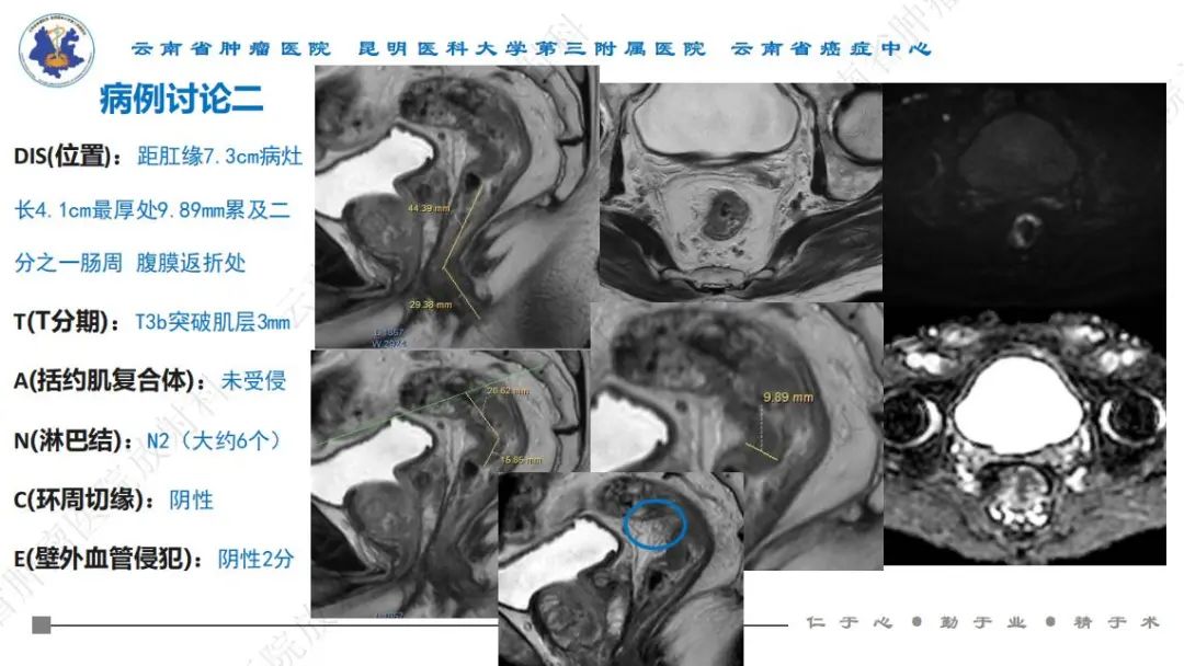 影像PPT - 【PPT】直肠癌磁共振解读-48
