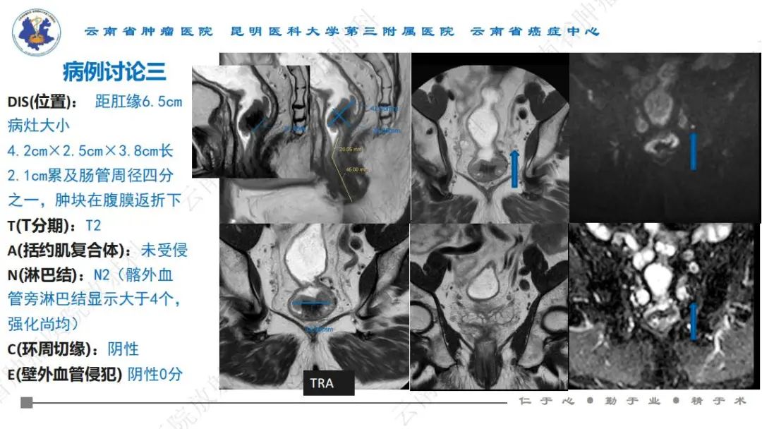 影像PPT - 【PPT】直肠癌磁共振解读-49