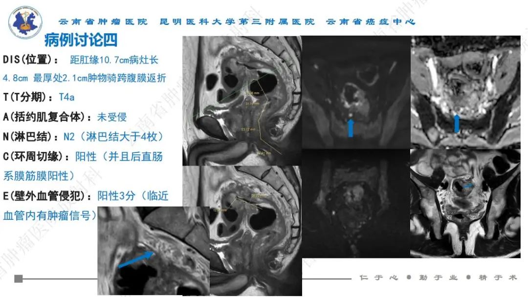 影像PPT - 【PPT】直肠癌磁共振解读-50