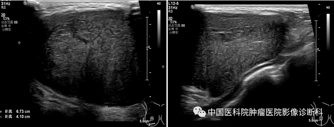 影像PPT - 【病例】乳腺幼年性纤维腺瘤1例MR影像-1