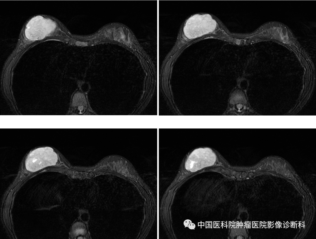 影像PPT - 【病例】乳腺幼年性纤维腺瘤1例MR影像-4