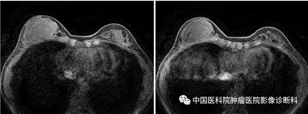 影像PPT - 【病例】乳腺幼年性纤维腺瘤1例MR影像-6