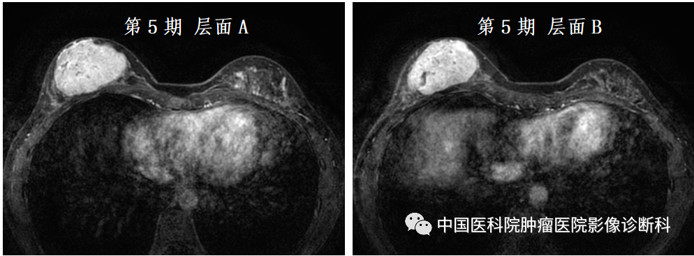 影像PPT - 【病例】乳腺幼年性纤维腺瘤1例MR影像-9