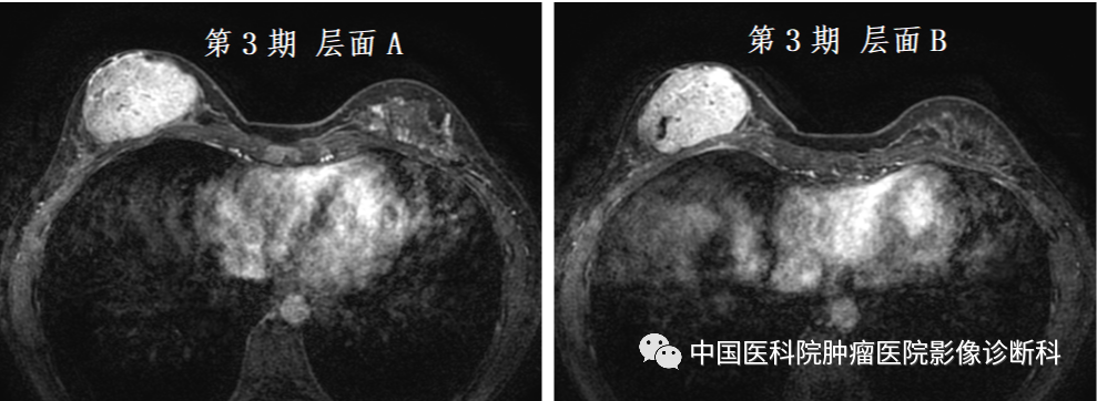 影像PPT - 【病例】乳腺幼年性纤维腺瘤1例MR影像-8