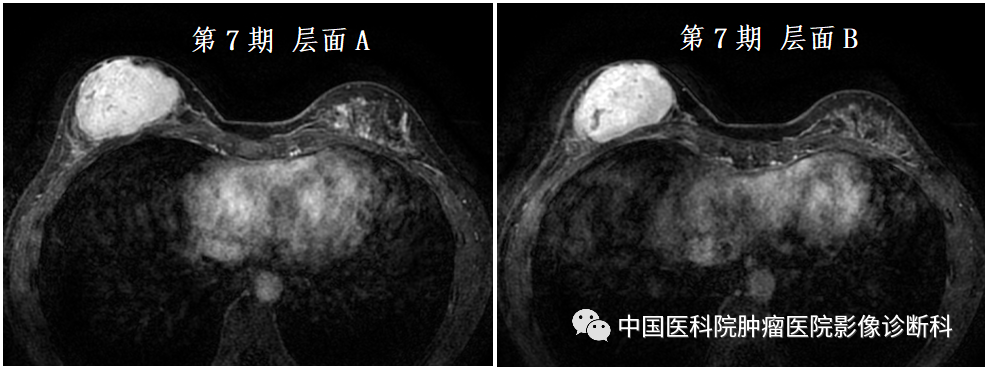 影像PPT - 【病例】乳腺幼年性纤维腺瘤1例MR影像-10