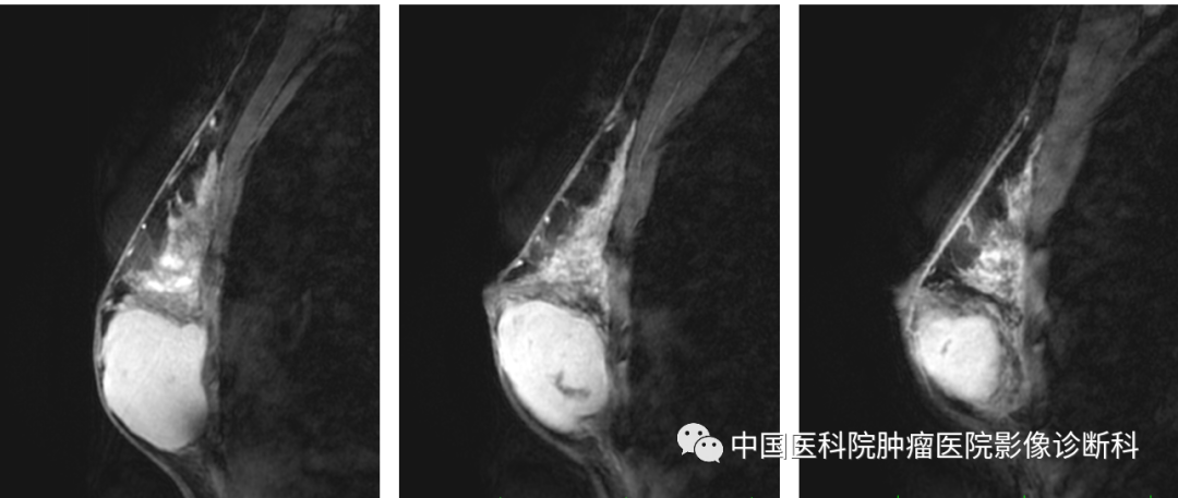 影像PPT - 【病例】乳腺幼年性纤维腺瘤1例MR影像-11