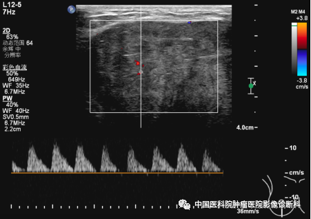 影像PPT - 【病例】乳腺幼年性纤维腺瘤1例MR影像-1