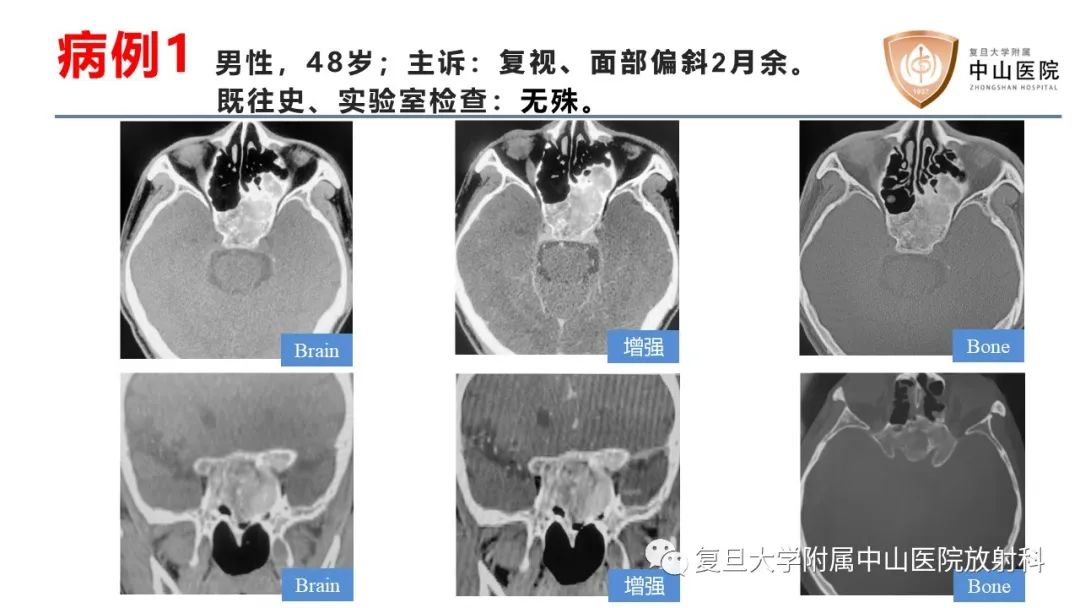 影像PPT - 【病例】颅骨血管畸形(血管瘤)2例CT及MR影像-2