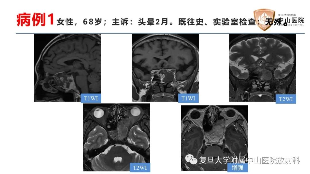 影像PPT - 【病例】颅骨血管畸形(血管瘤)2例CT及MR影像-3