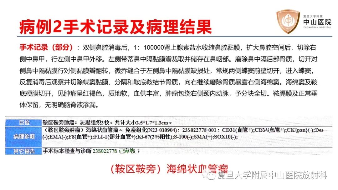 影像PPT - 【病例】颅骨血管畸形(血管瘤)2例CT及MR影像-7