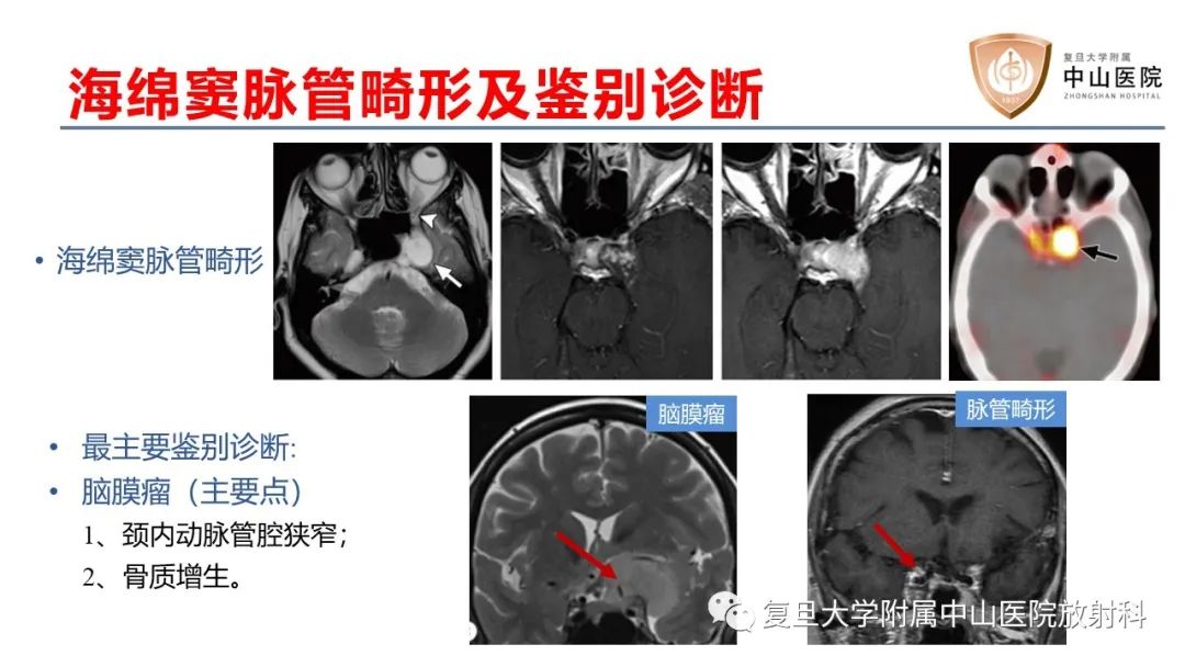 影像PPT - 【病例】颅骨血管畸形(血管瘤)2例CT及MR影像-10