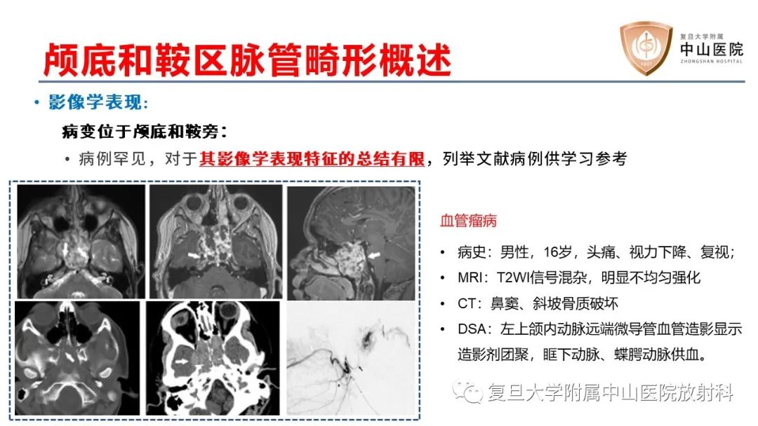 影像PPT - 【病例】颅骨血管畸形(血管瘤)2例CT及MR影像-11