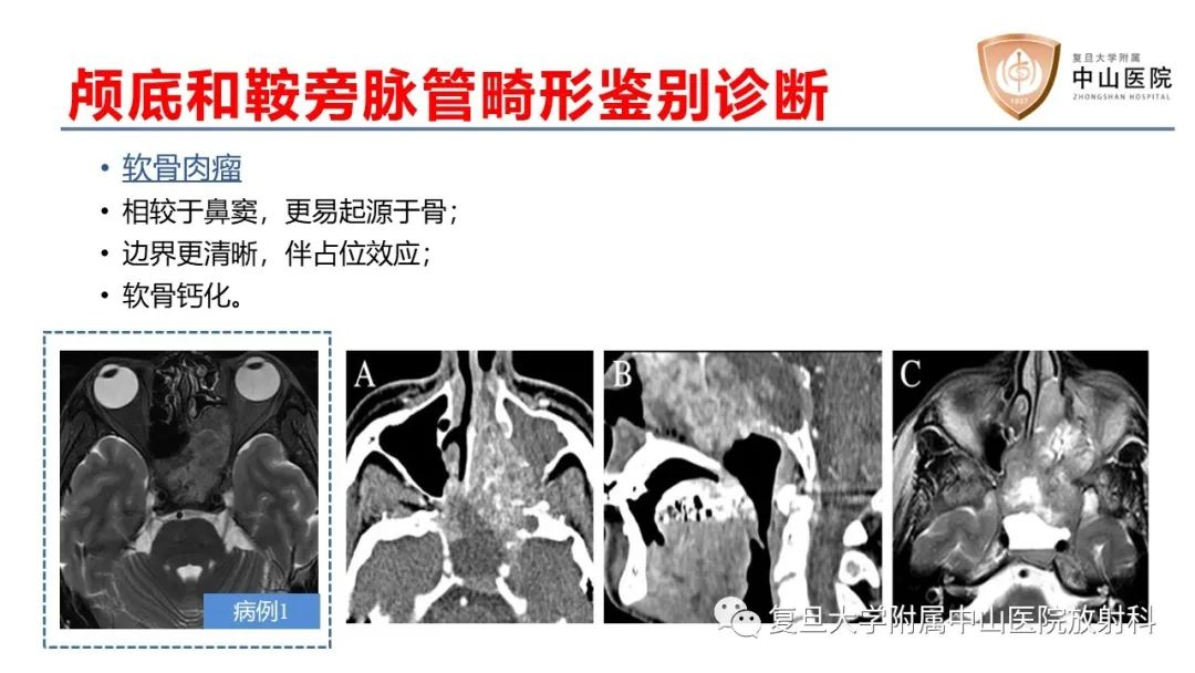 影像PPT - 【病例】颅骨血管畸形(血管瘤)2例CT及MR影像-13