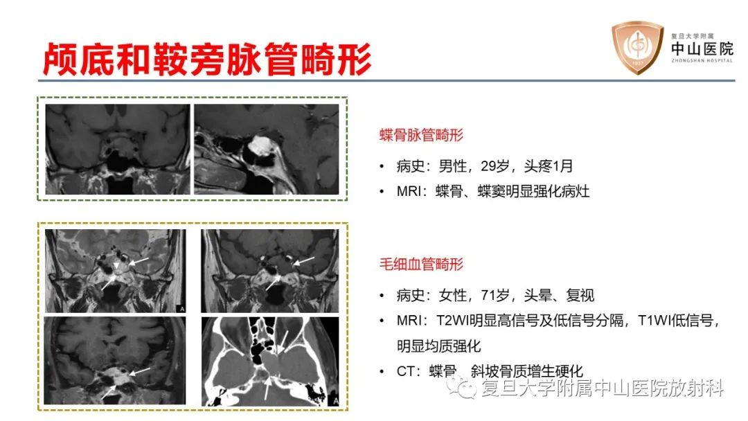 影像PPT - 【病例】颅骨血管畸形(血管瘤)2例CT及MR影像-12