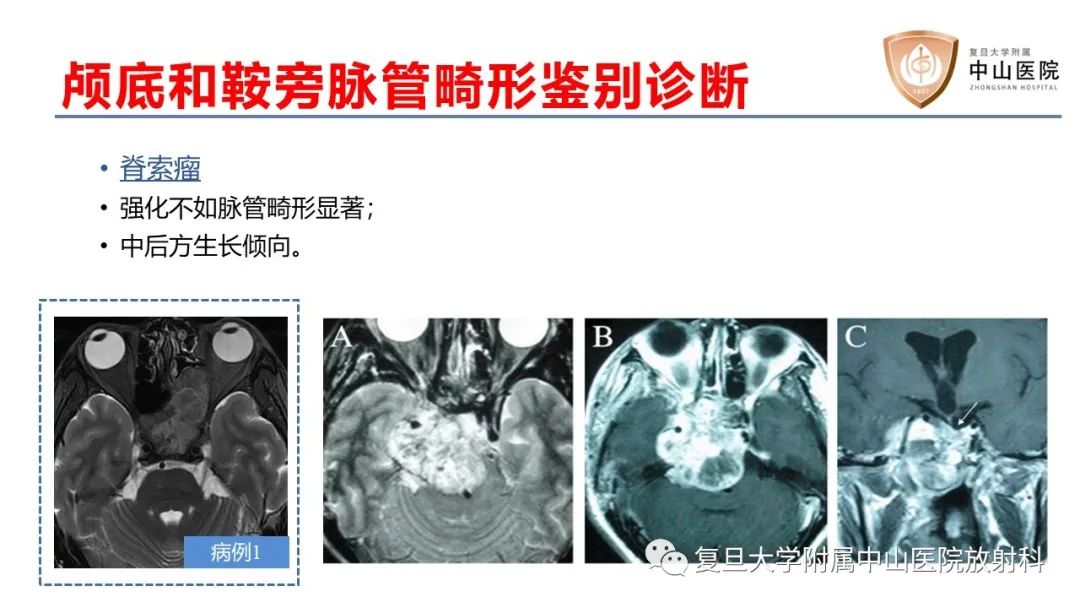 影像PPT - 【病例】颅骨血管畸形(血管瘤)2例CT及MR影像-14