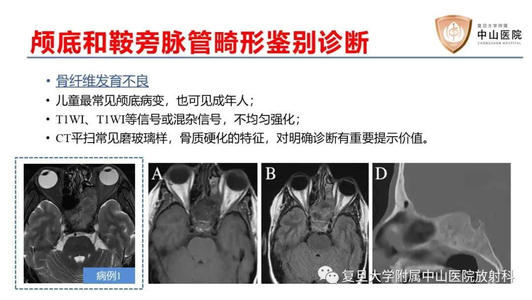 影像PPT - 【病例】颅骨血管畸形(血管瘤)2例CT及MR影像-15