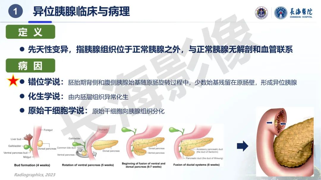 影像PPT - 【PPT】异位胰腺的影像特征及并发症-3