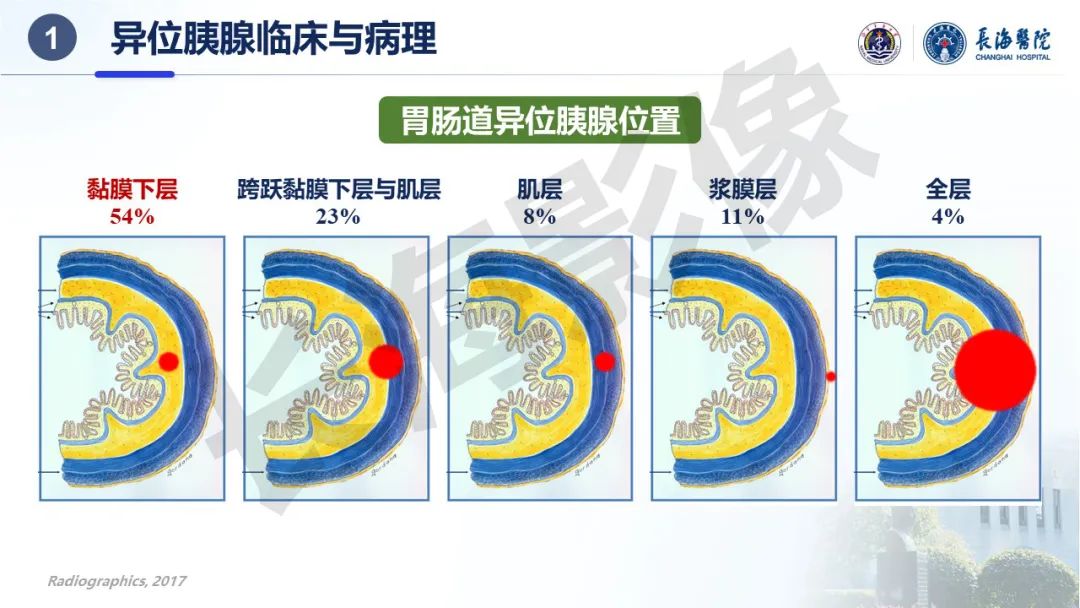 影像PPT - 【PPT】异位胰腺的影像特征及并发症-5