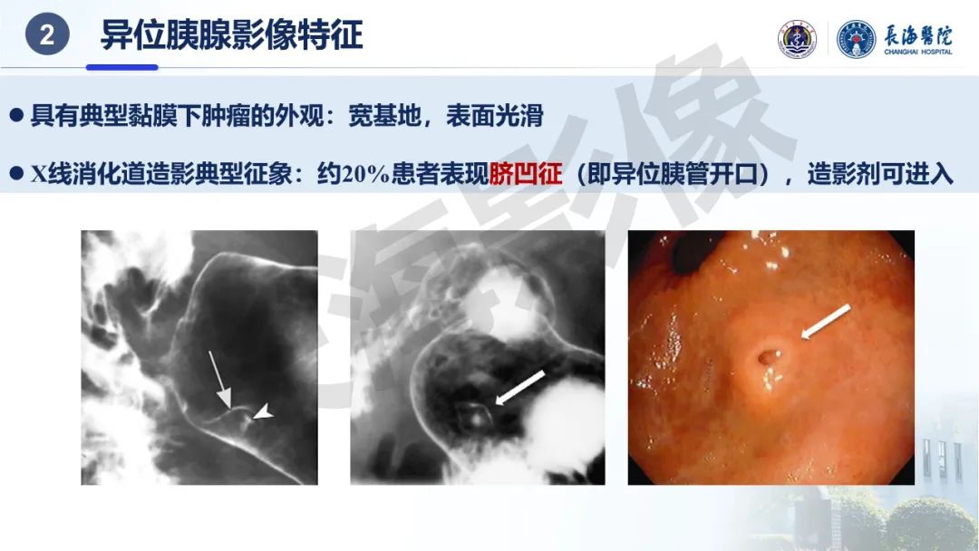 影像PPT - 【PPT】异位胰腺的影像特征及并发症-8