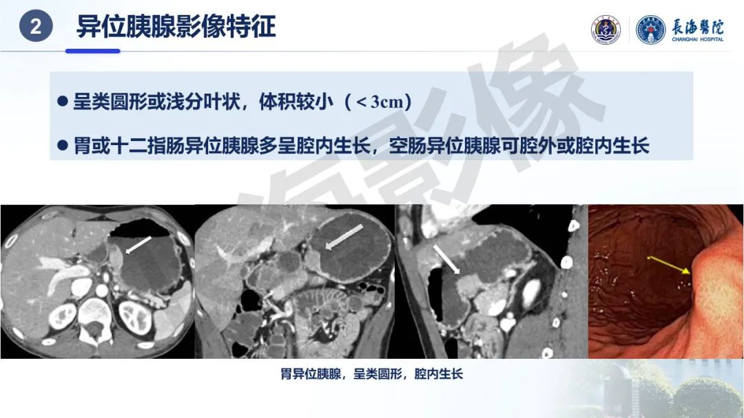 影像PPT - 【PPT】异位胰腺的影像特征及并发症-9