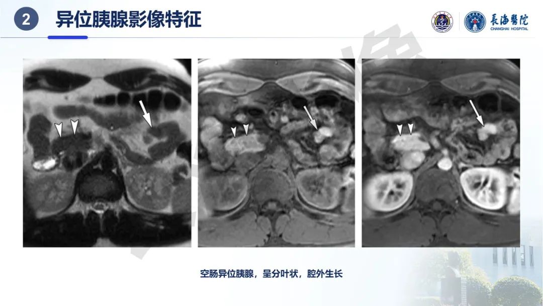 影像PPT - 【PPT】异位胰腺的影像特征及并发症-10