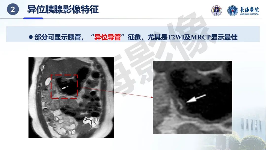 影像PPT - 【PPT】异位胰腺的影像特征及并发症-11